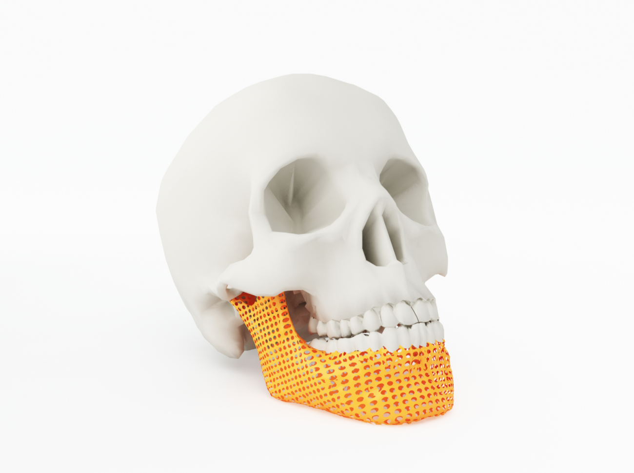 “Osseo-friendly” implants provide far greater staying power than their conventional counterparts.